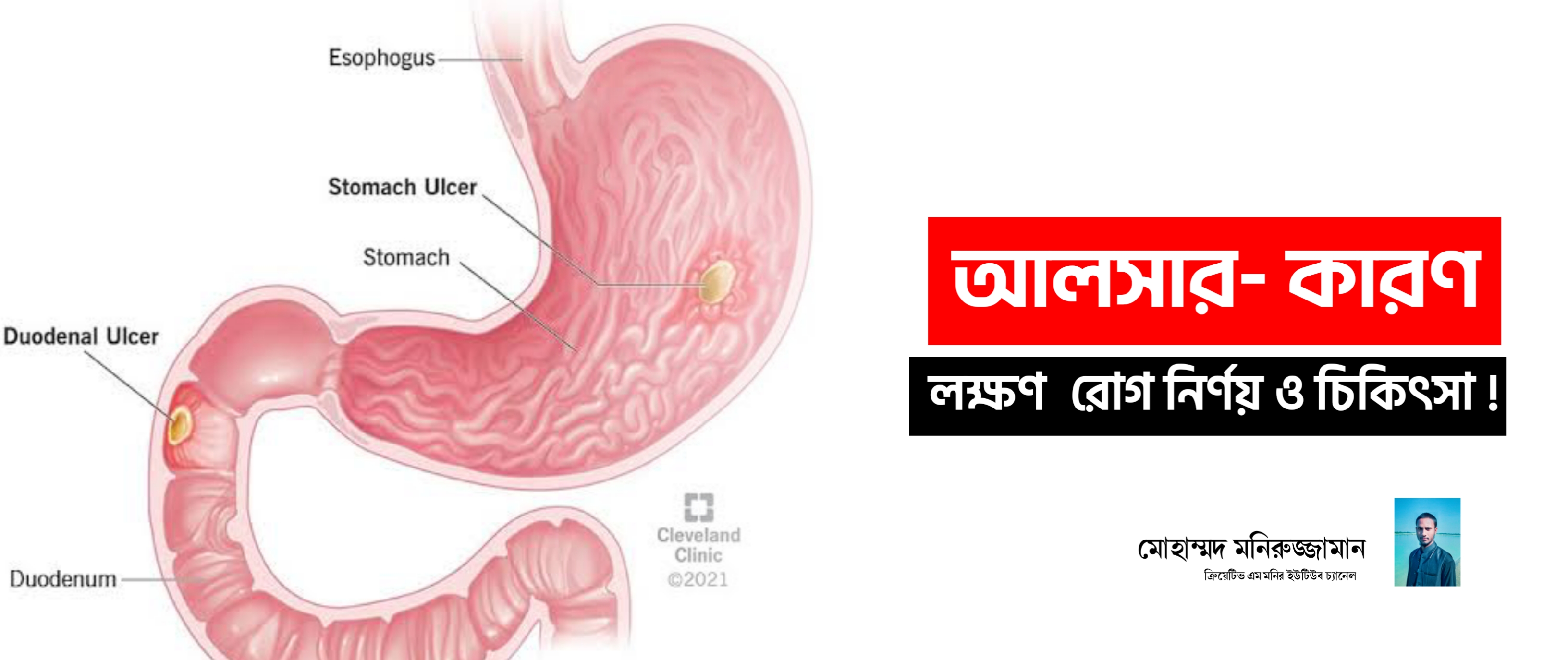 
 আলসার_ 